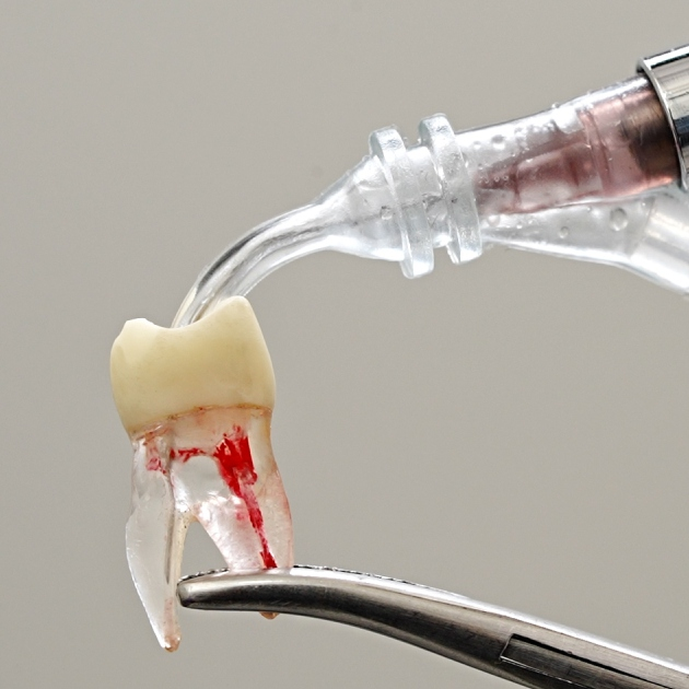 I-N-S in clinical use on extracted tooth